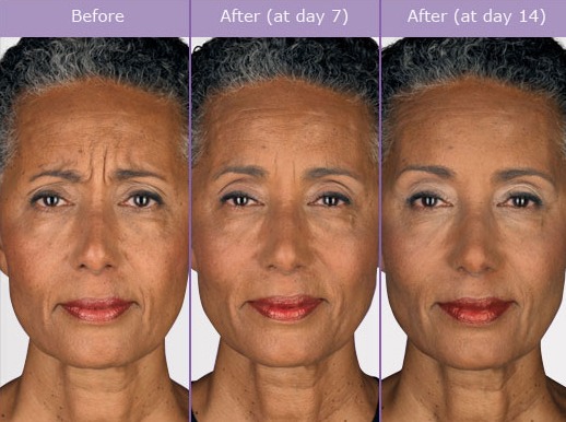 Not known Facts About Botox® Cosmetic And Restylane thumbnail
