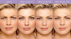 Botox | Laugh Line Reduction | Plastic Surgery Pasadena Burbank CA