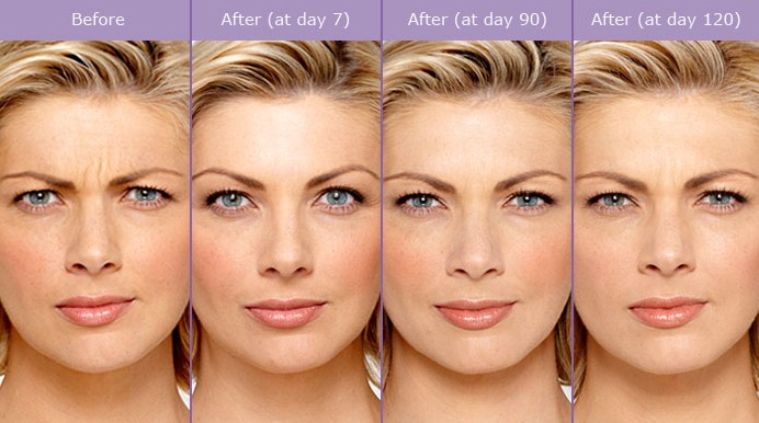 Botox Before And After Laugh Lines