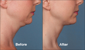 How long do Kybella Injections last?