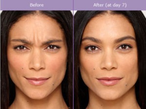 How long does Botox last?