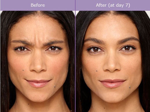 An Unbiased View of Best Botox Pasadena, Ca - Last Updated February 2023 thumbnail