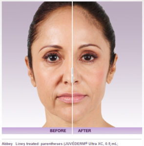 What is Juvederm Injectable Filler used for?