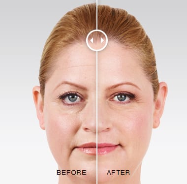 Juvederm Injectable Filler Before and After Photos