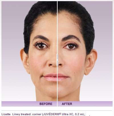 Juvederm Injectable Filler Before and After Photos