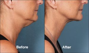 Facial &#038; Neck Liposculpture