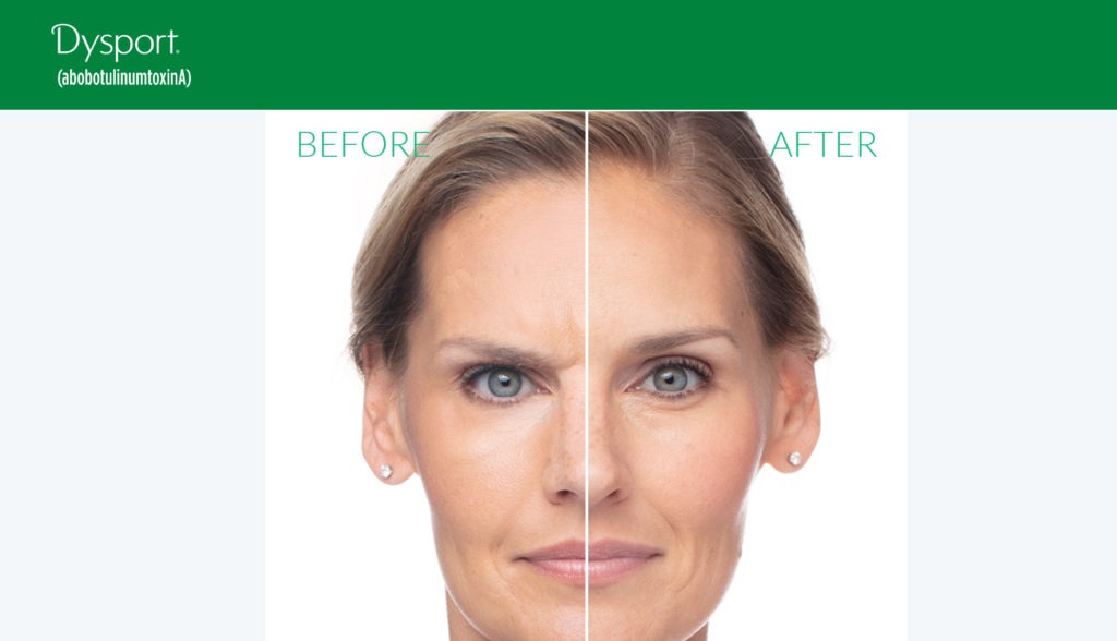 Wrinkle Relaxers: Botox, Dysport, Xeomin