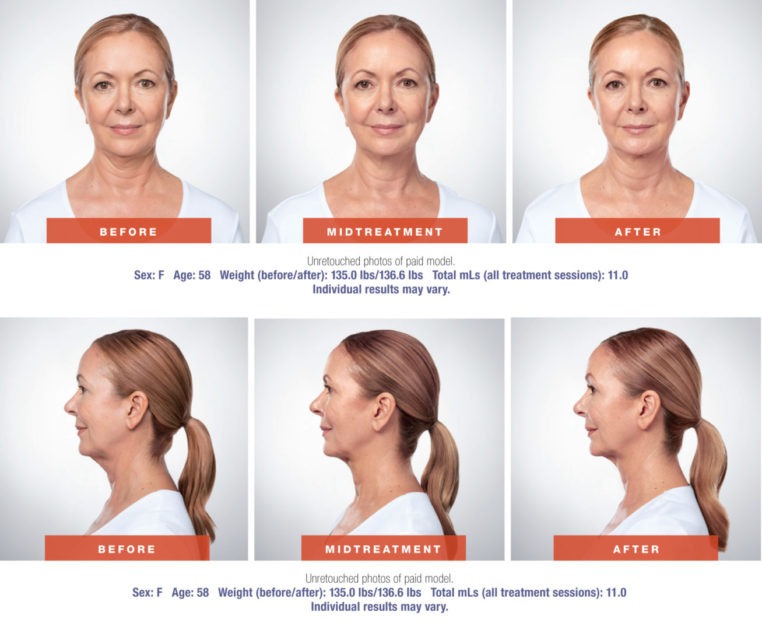 Kybella