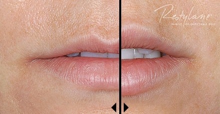 Soft Tissue Fillers: Juvederm, Restylane, Voluma