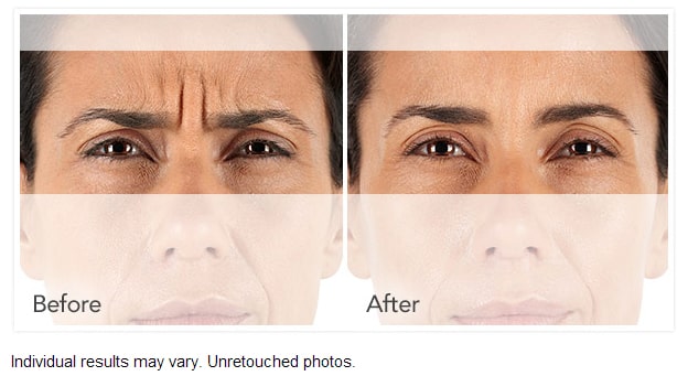 Wrinkle Relaxers: Botox, Dysport, Xeomin