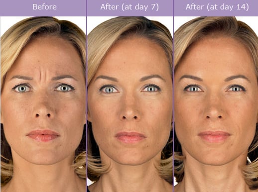 Wrinkle Relaxers: Botox, Dysport, Xeomin