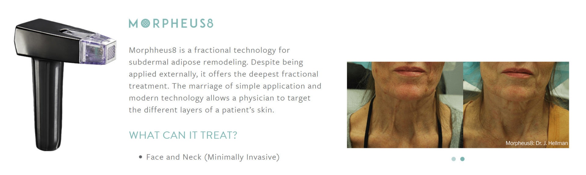 Skin Tightening, Botox and Lip Fillers by Skinsation LA
