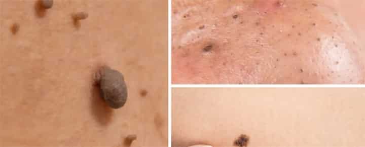 Mole / Skin Tag Removal Off The Face 