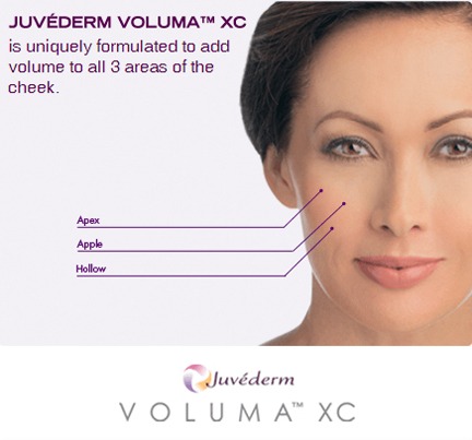 How Much Does Juvederm VOLUMA Cost?