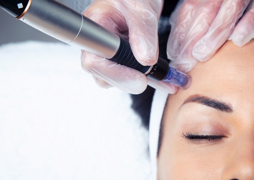 Microneedling vs Microdermabrasion