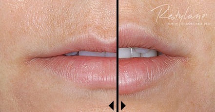 Restylane Facial Filler Before And After Pictures
