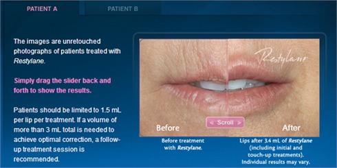 What is Restylane®? Fill Facial Wrinkles And Enhance Your Lips