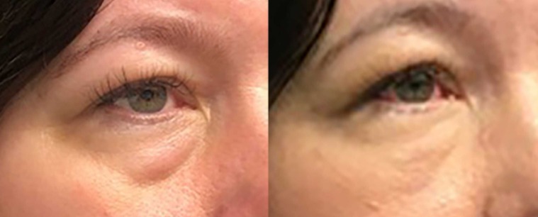AccuTite Radiofrequency (RF) Energy To Lift And Tighten Sagging Eye Brows