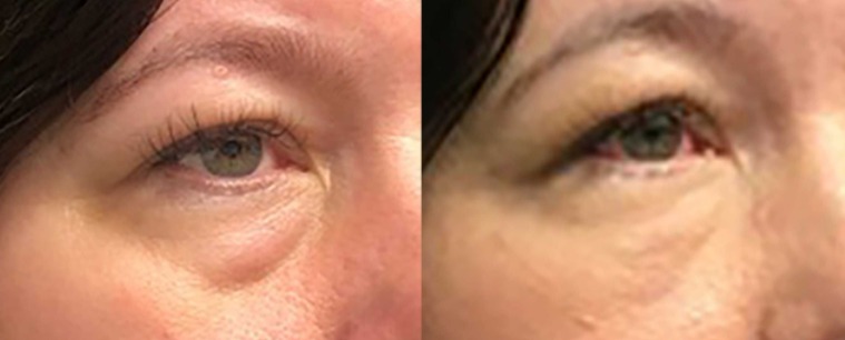 https://www.ejyfacialplastics.com/wp-content/uploads/2021/12/AccuTite-Radiofrequency-RF-Energy-To-Lift-And-Tighten-Sagging-Eye-Brows.jpg