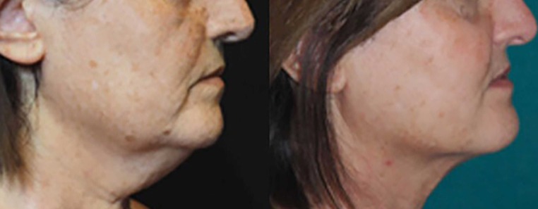 AccuTite Radiofrequency (RF) Energy To Tighten Loose Skin In The Neck