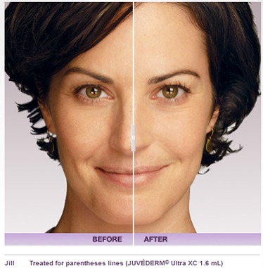 Soft Tissue Dermal Fillers: Juvederm, Restylane, Voluma