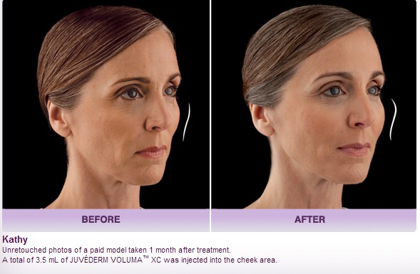 Restore Volume To The Cheeks And Smile Lines With Dermal Fillers